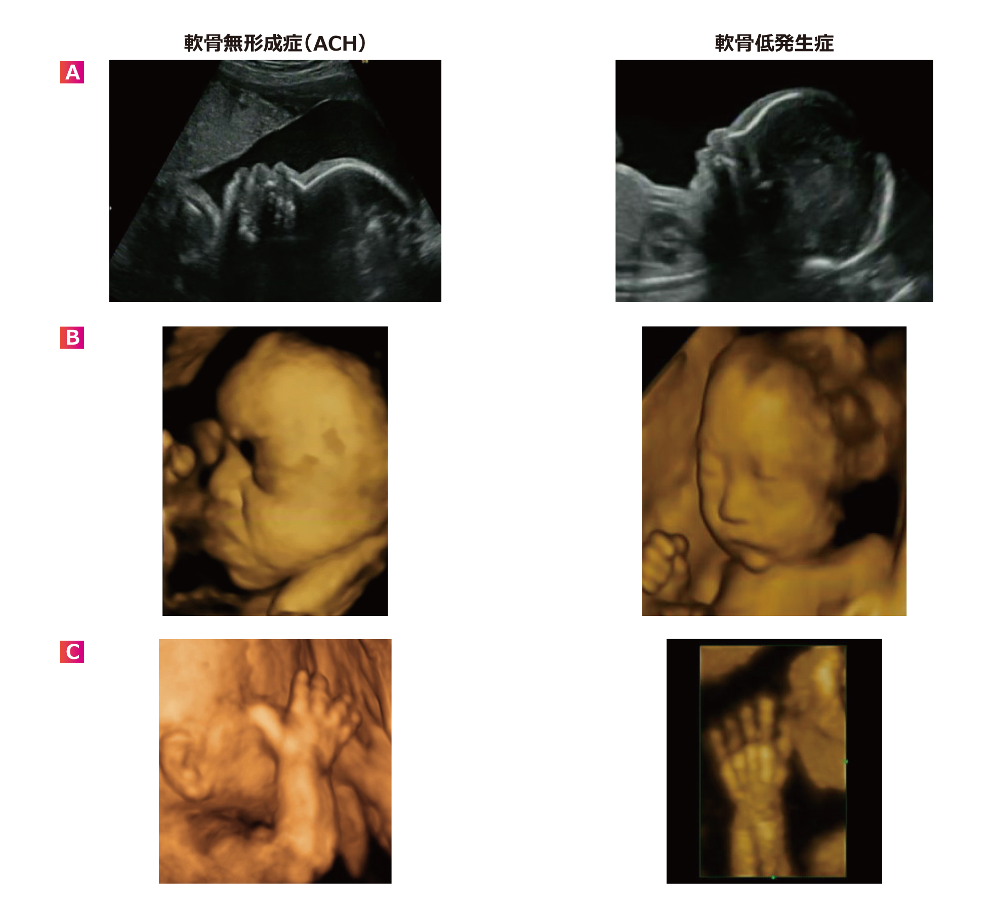 軟骨無形成症（ACH）と軟骨低発生症の胎児超音波所見の違い