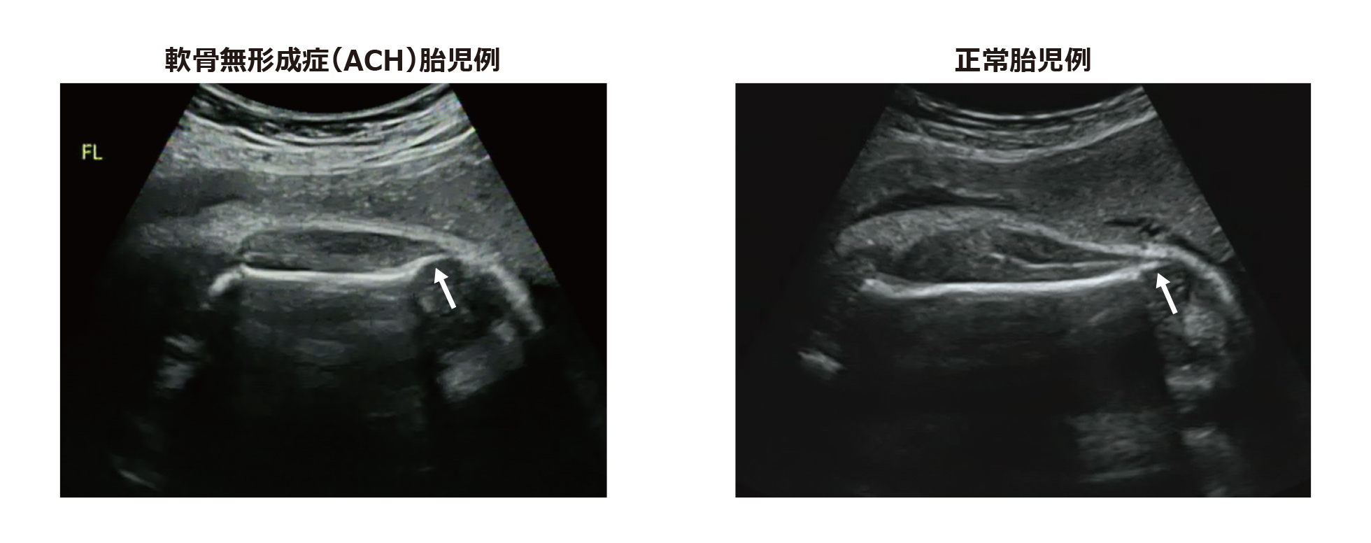 軟骨無形成症（ACH）胎児，正常胎児における大腿骨長（FL）の計測