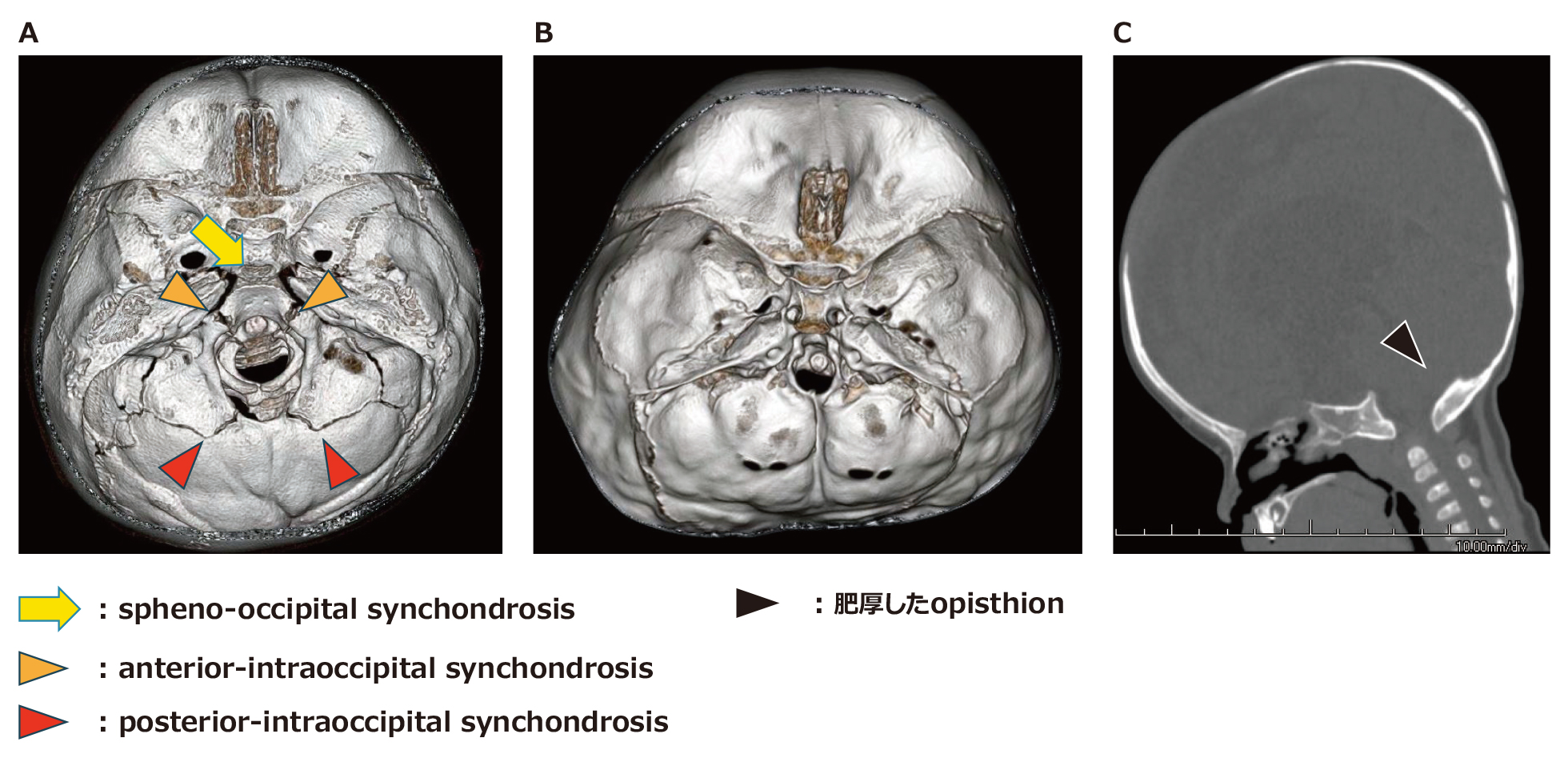 大後頭孔の軟骨結合（synchondrosis）と軟骨無形成症（ACH）における大後頭孔狭窄