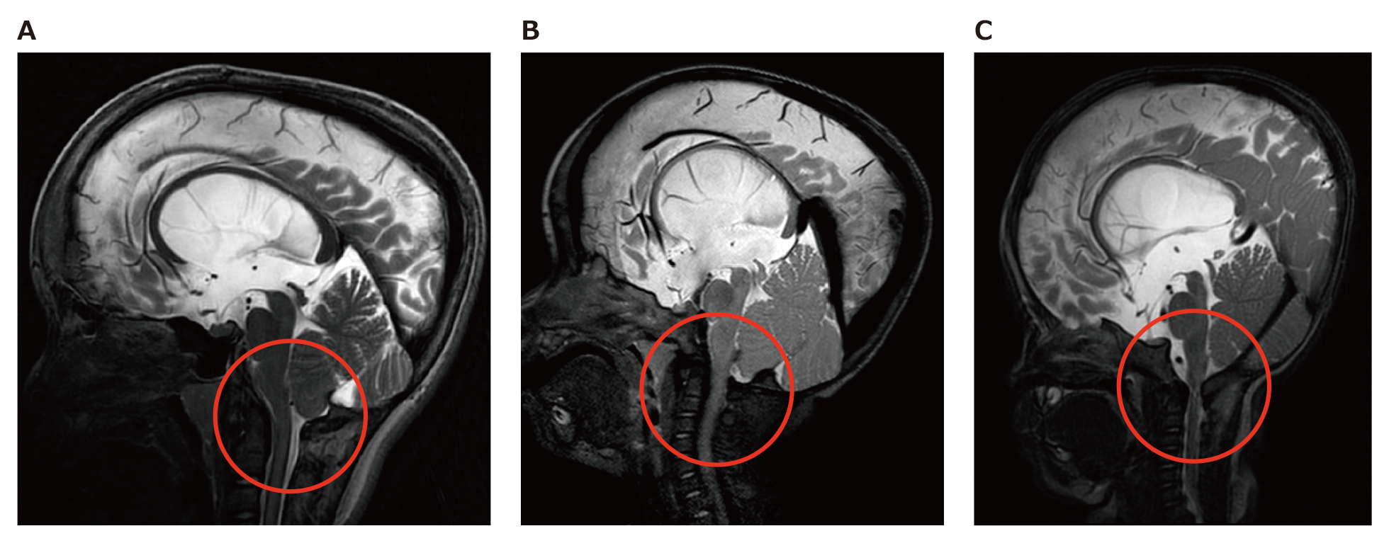 Achondroplasia Foramen Magnum Score（AFMS）