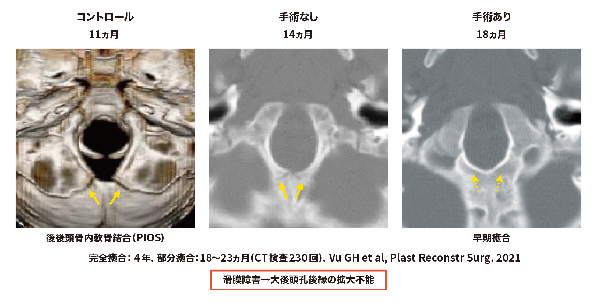 軟骨無形成症（ACH）患者の大後頭孔狭窄