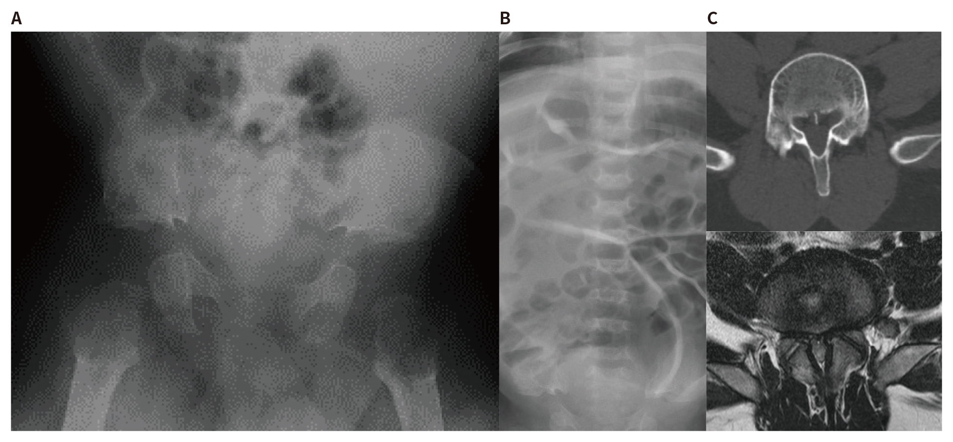 軟骨無形成症（ACH）の画像所見